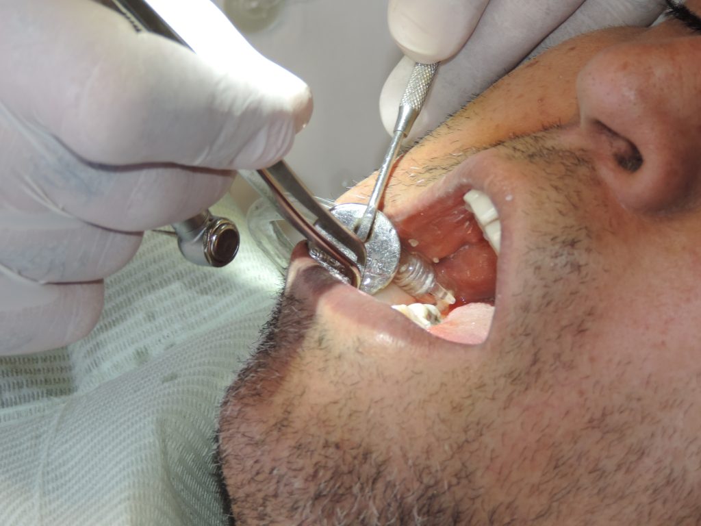 چند دلیل شکستن دندان: