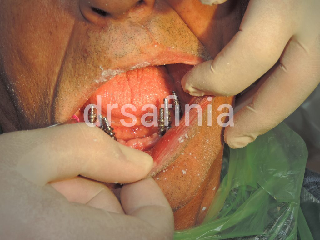 ایمپلنت دندان چیست؟؟