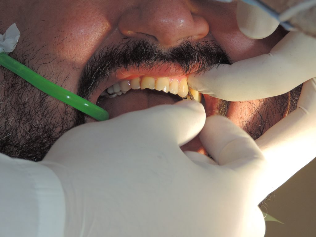 نکات مهم بعد از جراحی ایمپلنت(ایمپلنت فرمانیه)