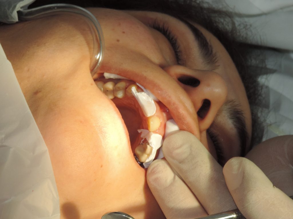 چندنوع ایمپلنت داریم؟